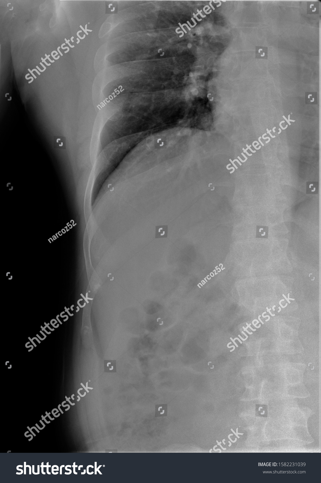 Normal Radiography Chest Organs Direct Projection Stock Photo ...