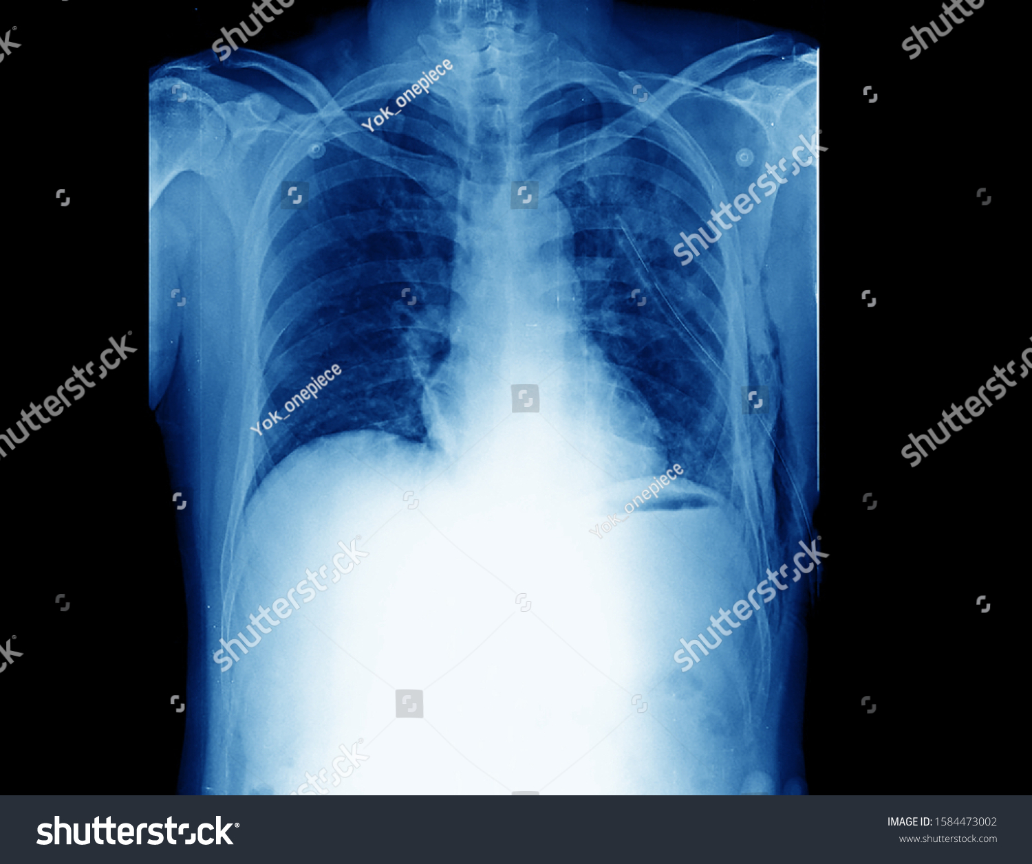 Chest Xray Showing Tension Pneumothorax On Stock Photo 1584473002 ...