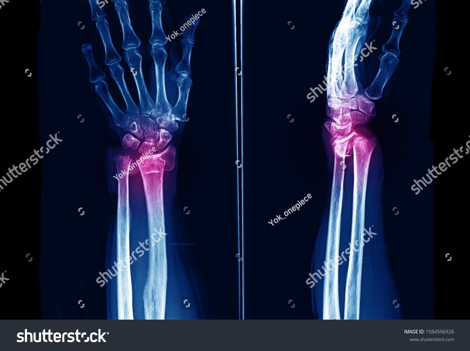 Xray Wrist Forearm Showing Closed Fracture Stock Photo 1584596926 ...