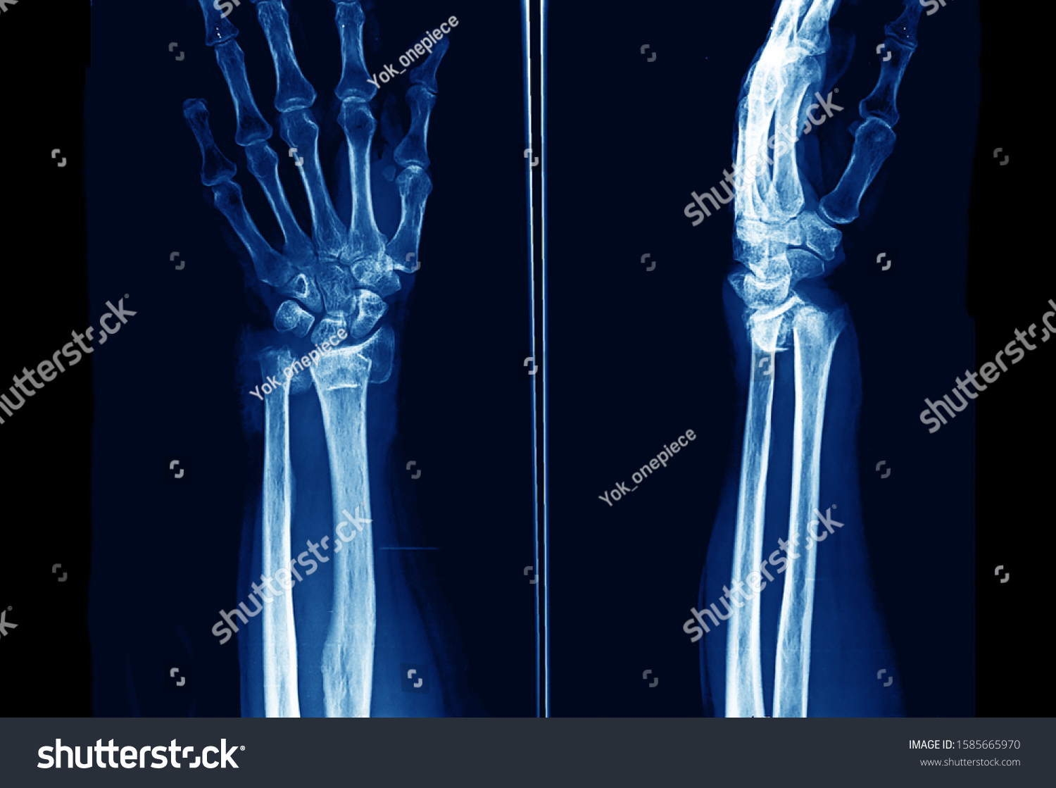 Xray Wrist Forearm Showing Closed Fracture Stock Photo 1585665970 ...