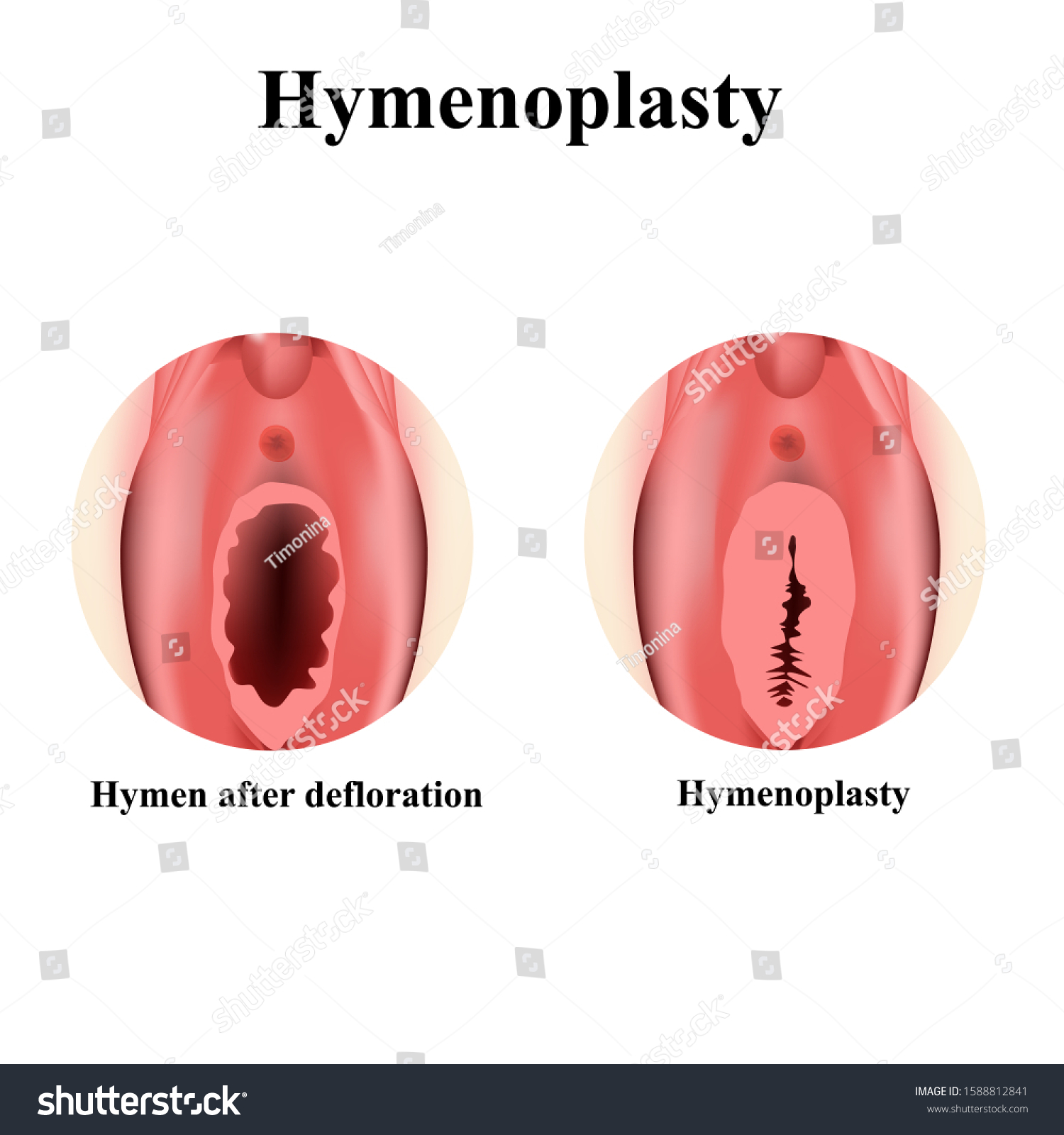 Structure Vulva Hymen Hymenoplasty Hymen After: стоковая векторная графика ...