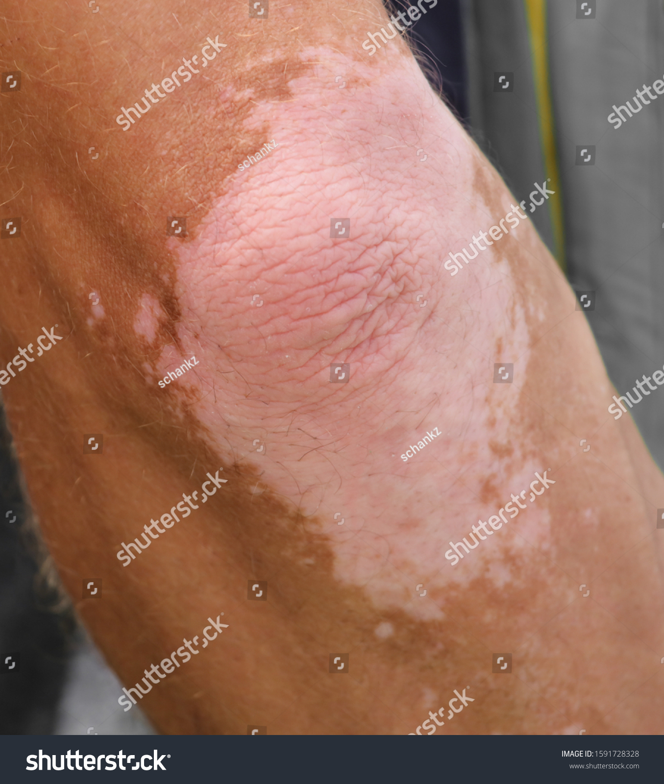 White Spots On Hand Skin Disease 스톡 사진 1591728328 | Shutterstock