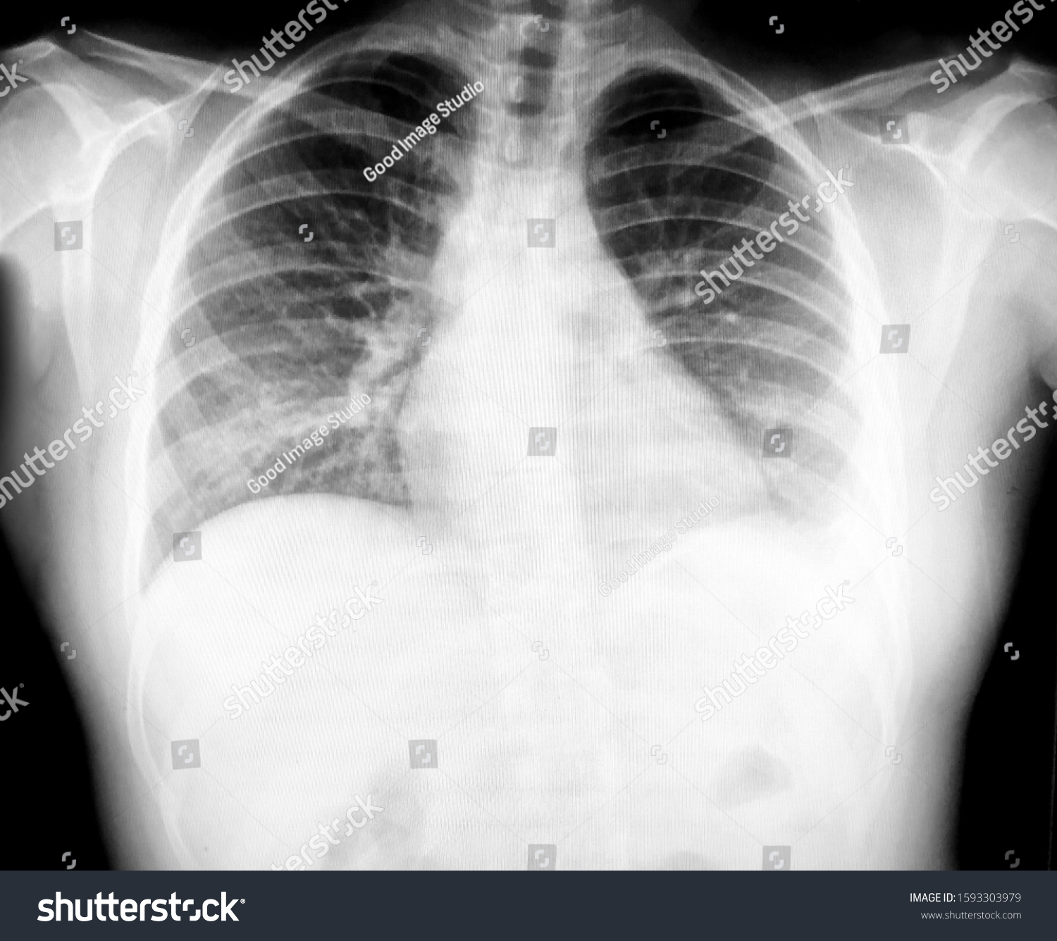 Chest Xray Pa Upright Shows Suboptimal Stock Photo 1593303979 ...