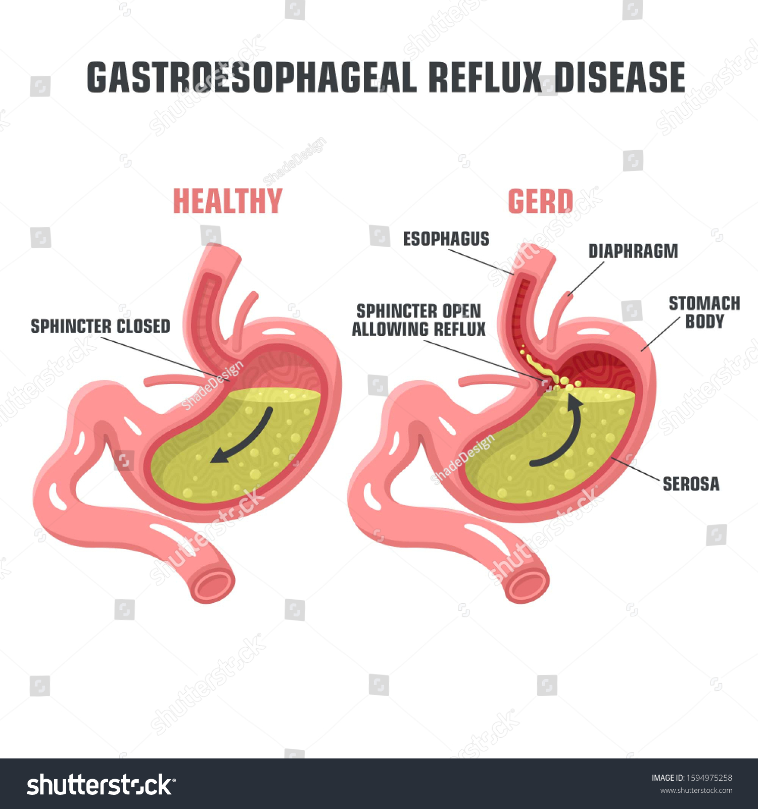 Vector Medical Icon Acid Reflux Stomach Stock Illustration 1594975258 ...