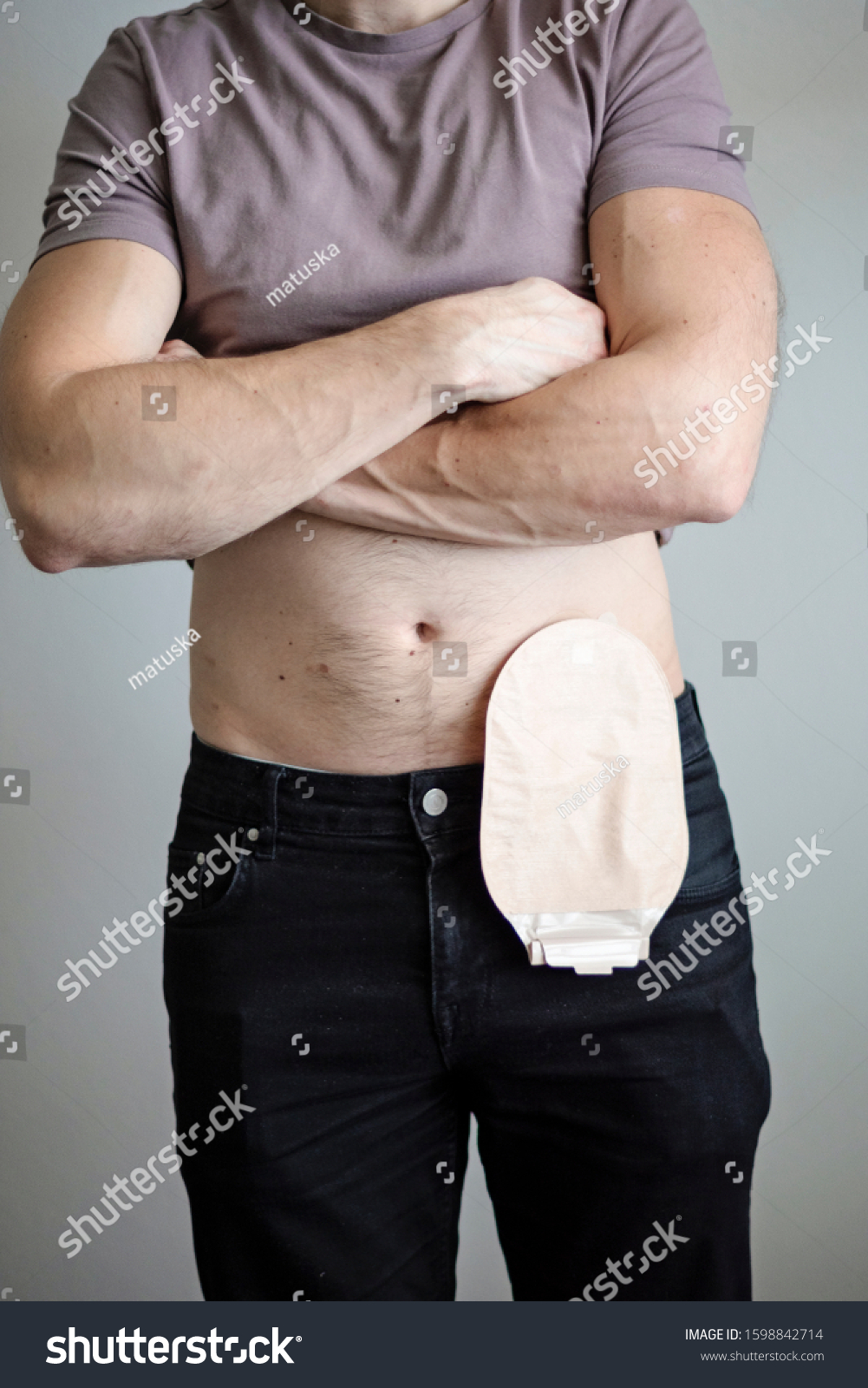 Front View On Colostomy Bag Attached Stock Photo 1598842714 | Shutterstock