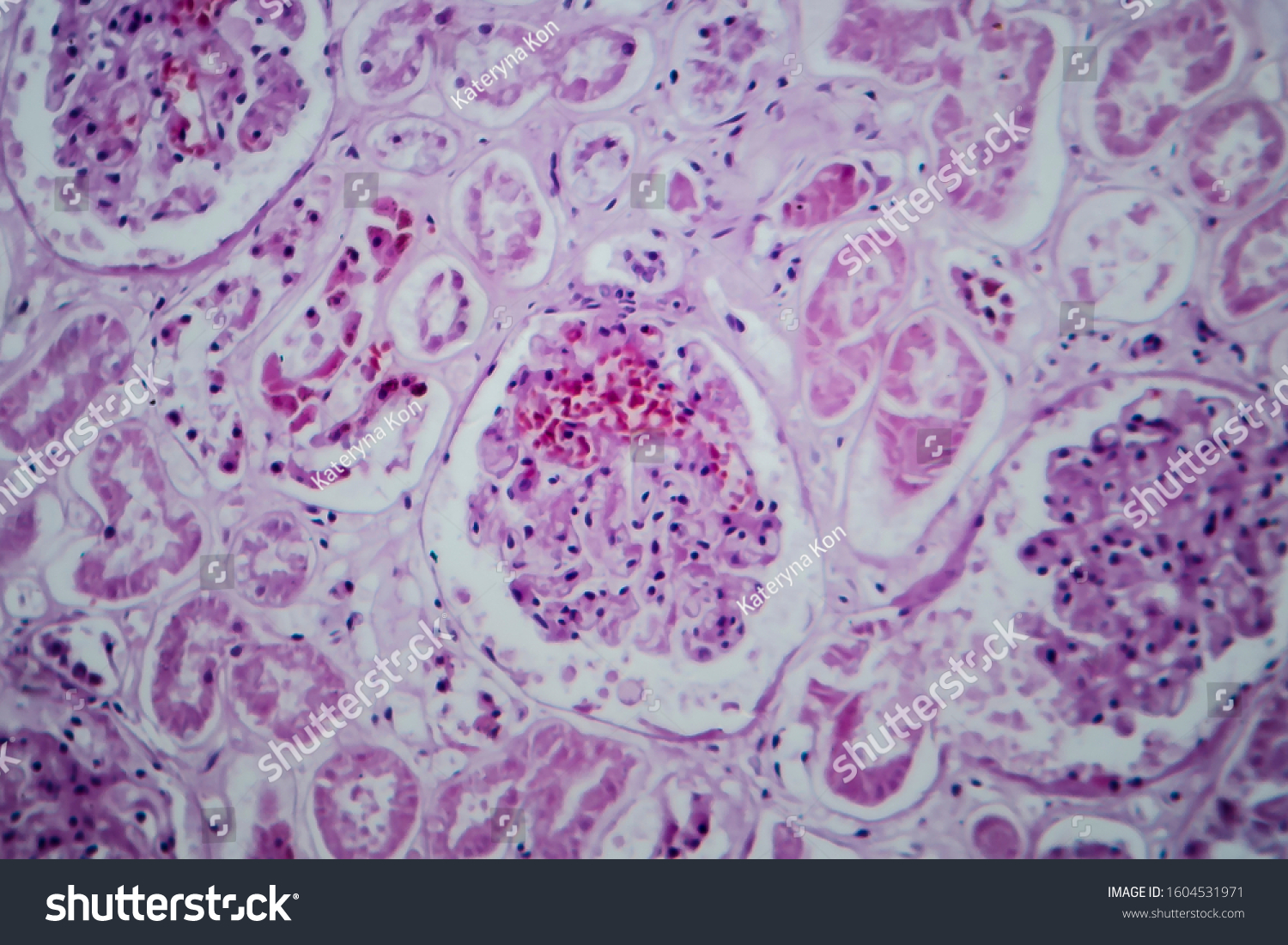 Acute Glomerulonephritis Light Micrograph Photo Under Stock Photo ...