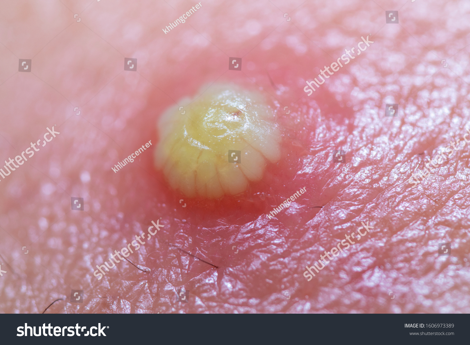 white pimple with puss