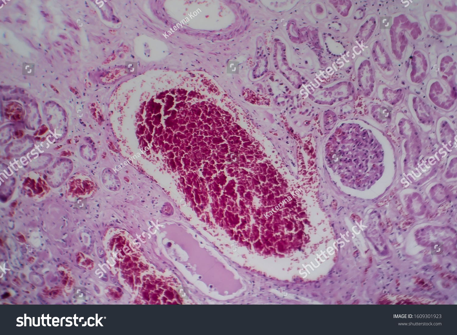 Acute Glomerulonephritis Light Micrograph Photo Under Stock Photo ...