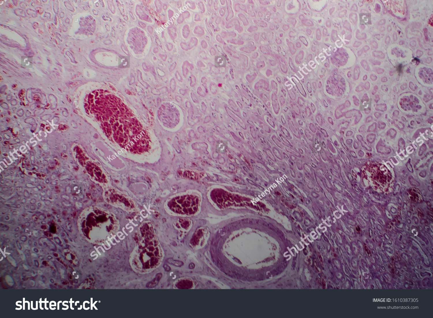 Acute Glomerulonephritis Light Micrograph Photo Under Stock Photo ...