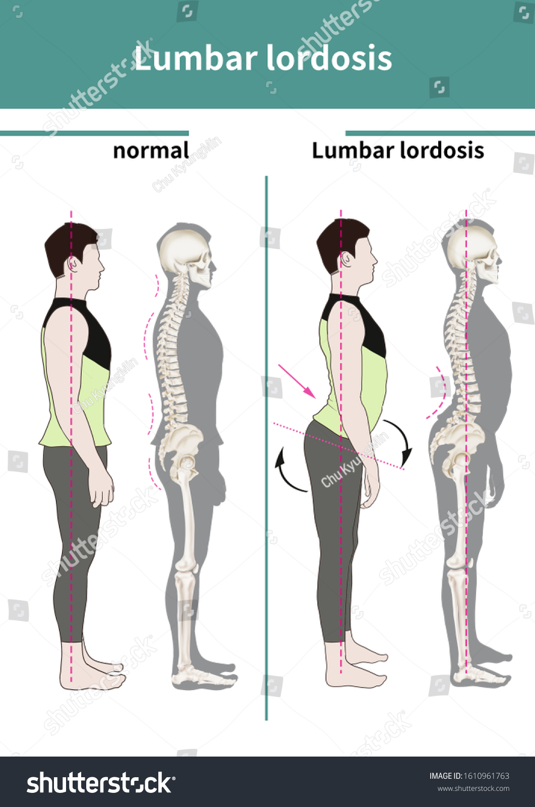 Medical Illustration Explain Lumbar Lordosis: стоковая иллюстрация, 1610961...