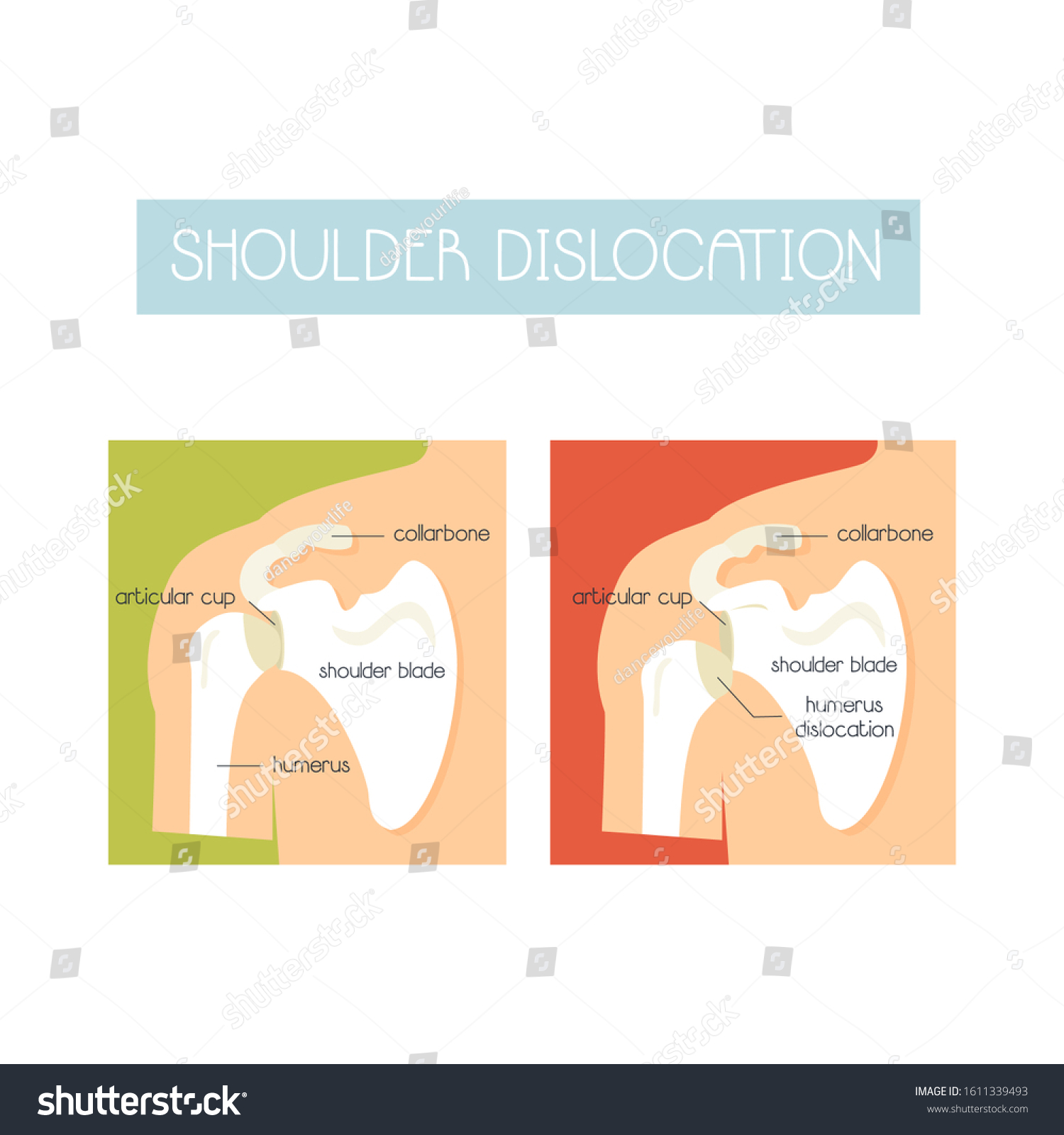 Vektor Stok Anatomical Vector Illustration Shoulder Dislocation Sport ...