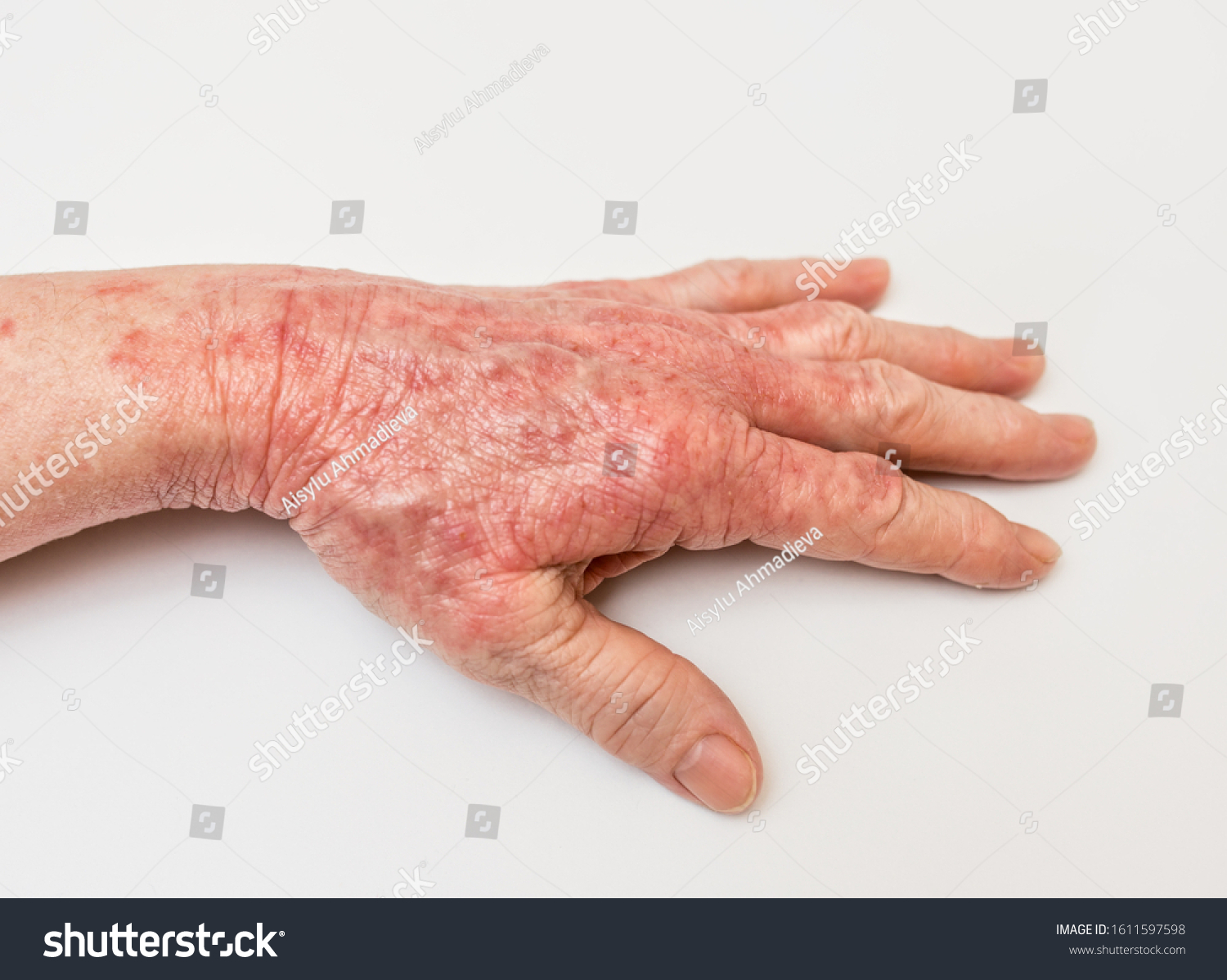 Womans Hands Atopic Dermatitis Food Allergy Stock Photo 1611597598 ...