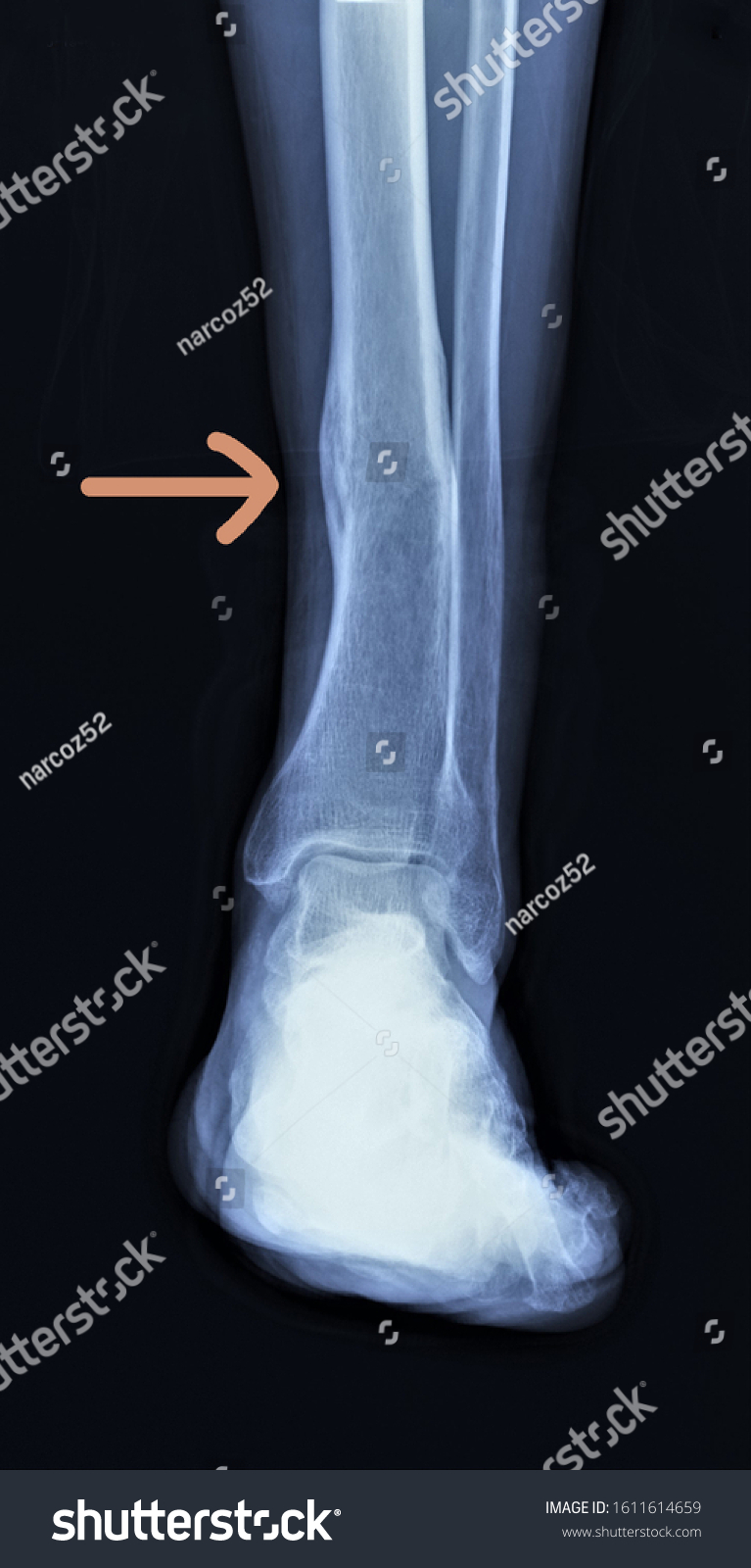 Xray Improperly Fused Tibial Fracture Stock Photo 1611614659 | Shutterstock