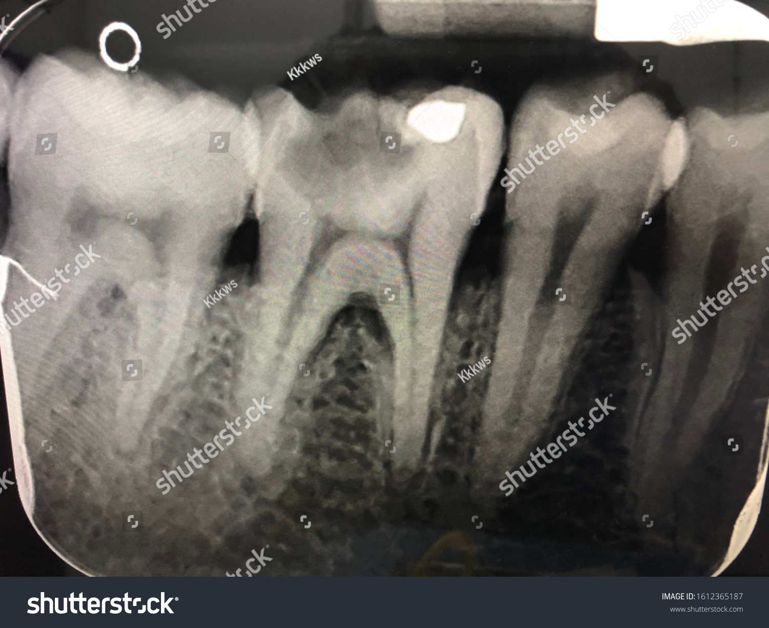 Dental Caries Permanent Molar Tooth Stock Photo 1612365187 