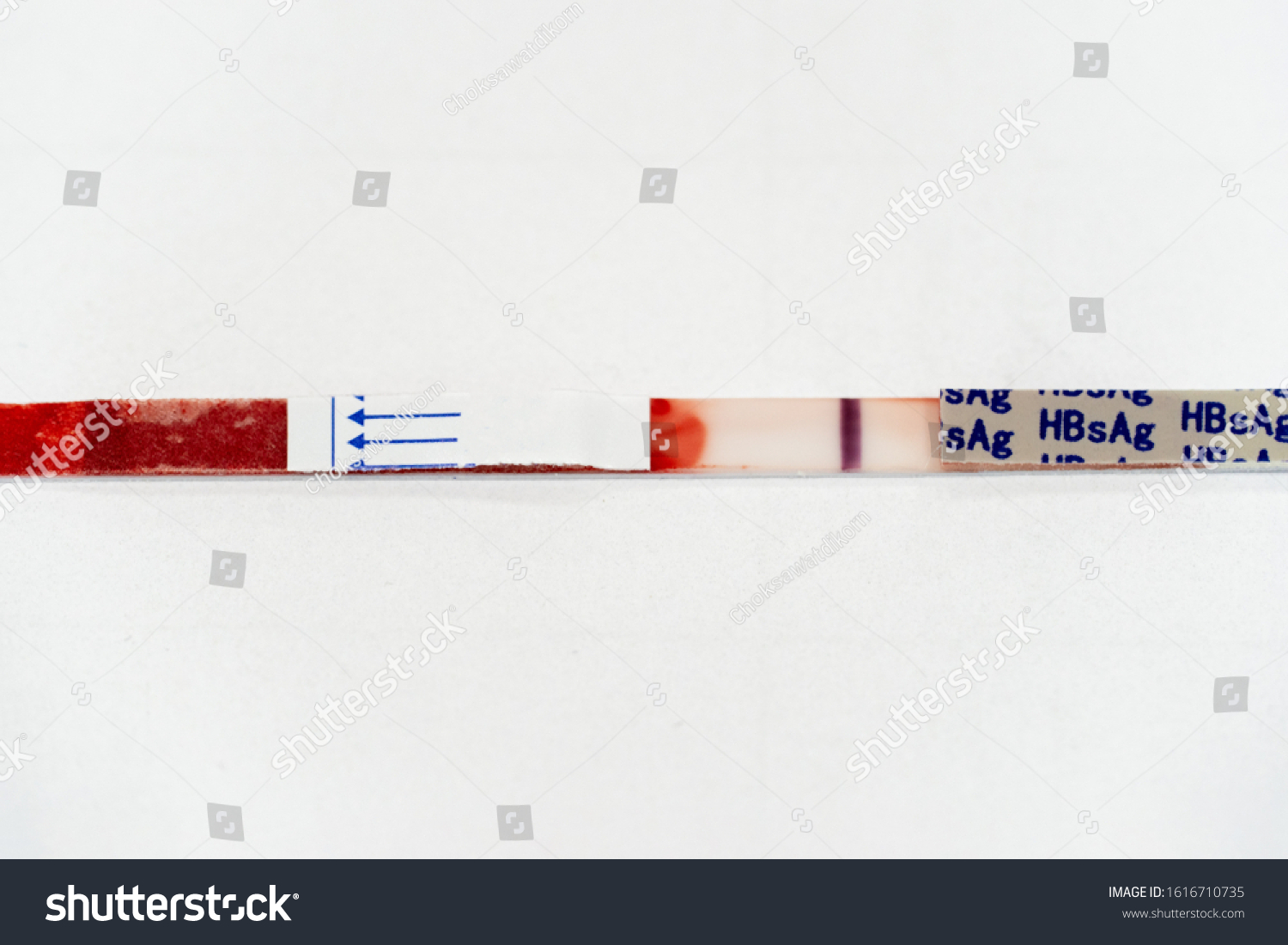 Hepatitis B Surface Antigen Hbsag Test Stock Photo 1616710735 ...