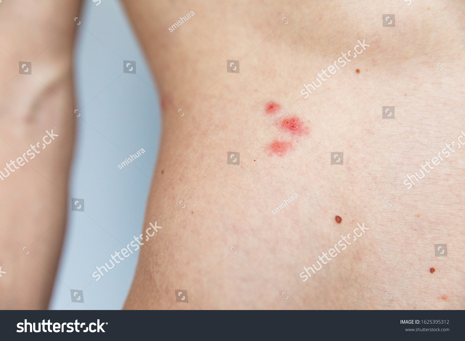 herpes-on-body-skin-disease-stock-photo-1625395312-shutterstock