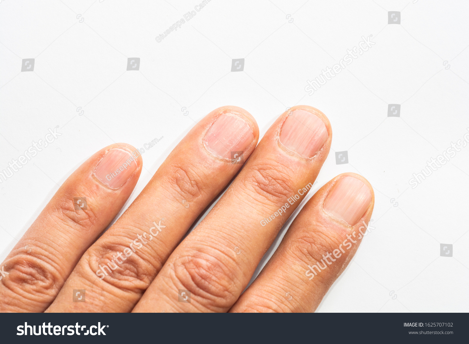 Vertical Ridges On Fingernails Symptoms Deficiency Stock Photo