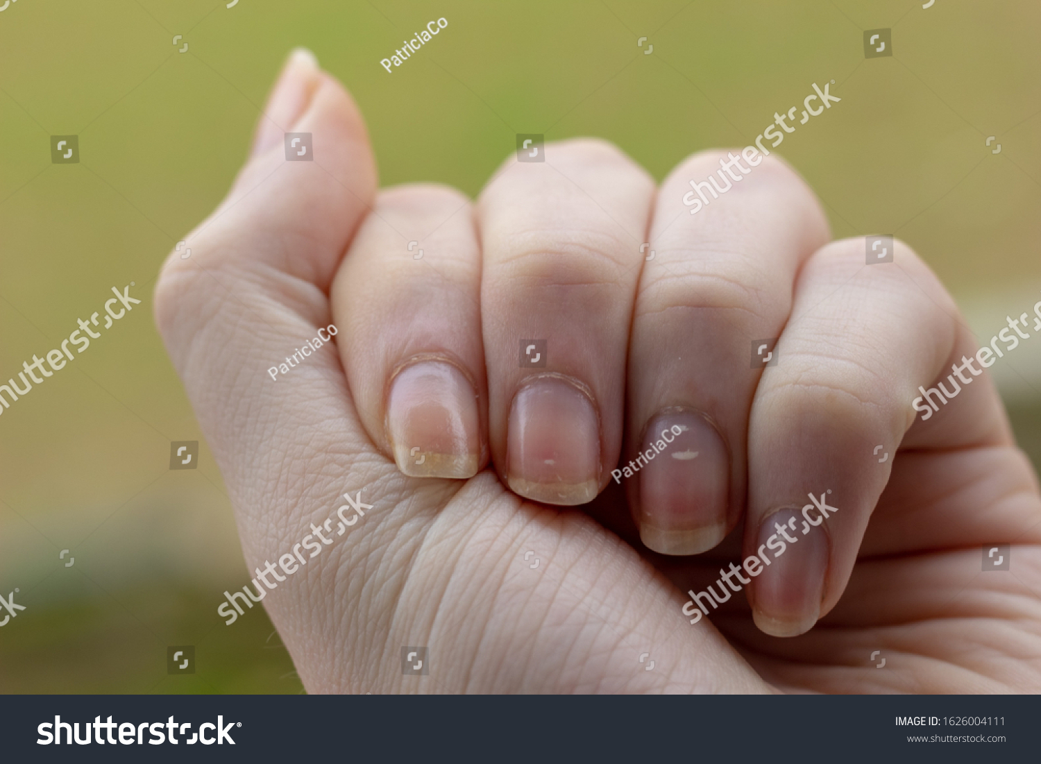 Nails White Spots Leukonychia Calcium Deficit Stock Photo 1626004111 ...