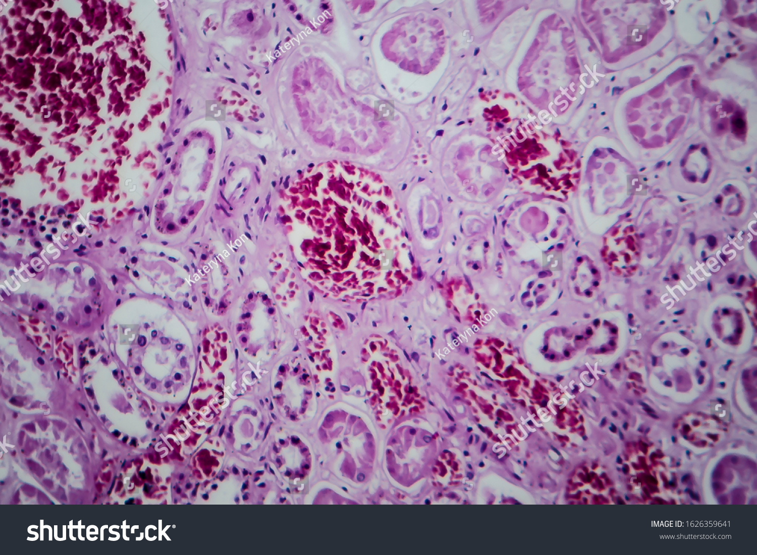 Acute Glomerulonephritis Light Micrograph Photo Under Stock Photo 