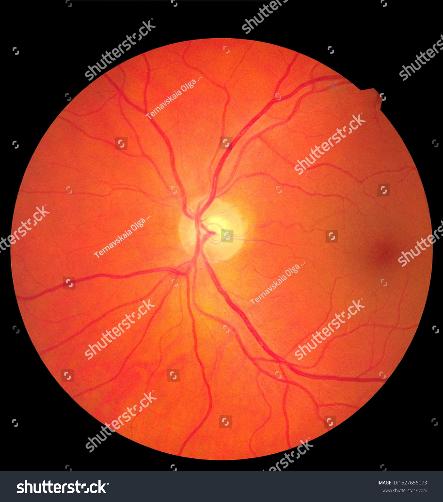 Ophthalmic Image Detailing Retina Optic Nerve Stock Photo 1627656073 ...