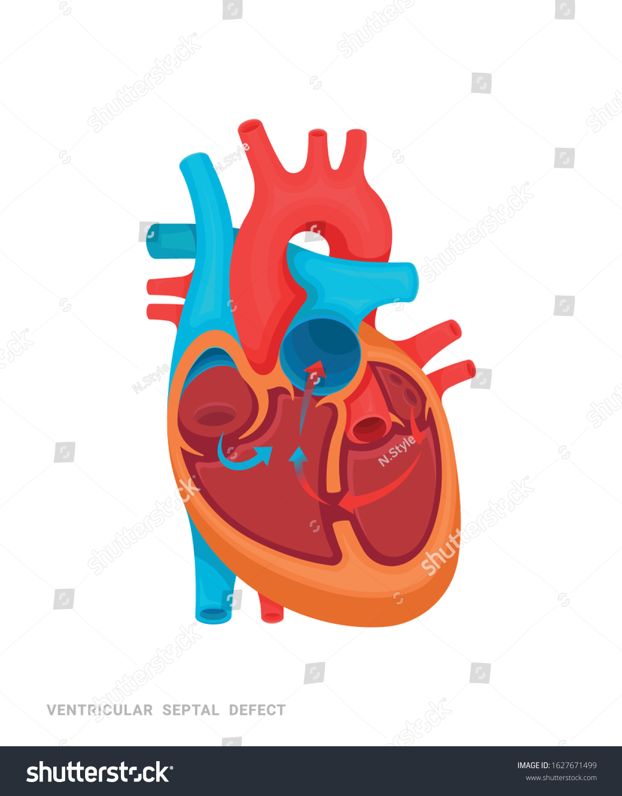 Heart Defect Ventricular Septal Defect Illustration Stock Vector ...