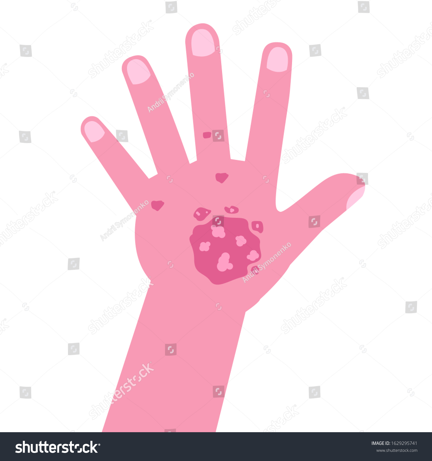 Hand Psoriasis Eczema Vector Illustration Stock Vector (Royalty Free ...