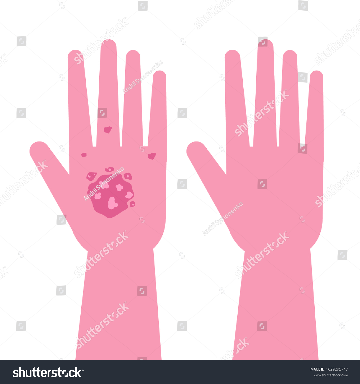 Hands Psoriasis Before After Treatment Vector Stock Vector (Royalty ...