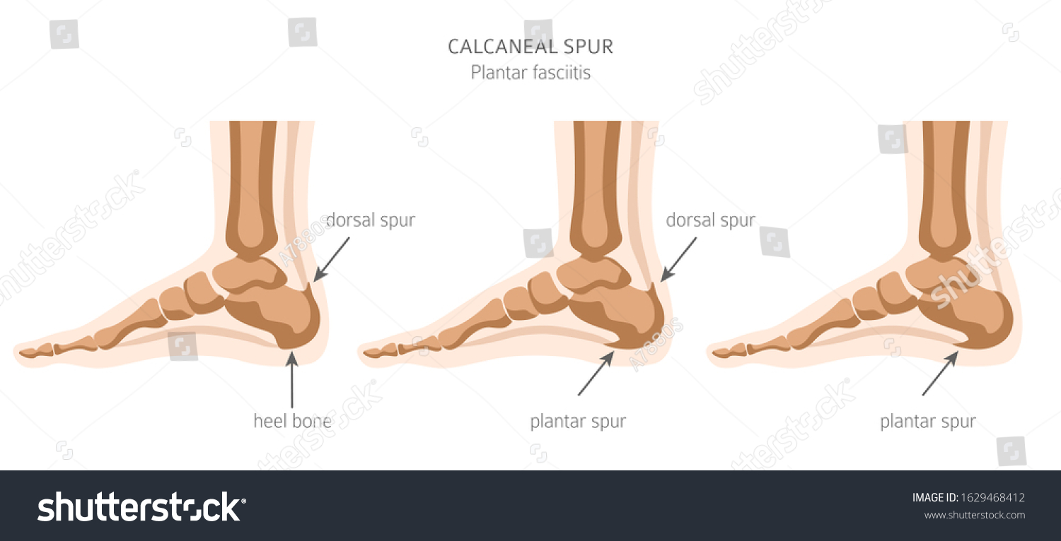 Calcaneal Spur Plantar Fasciitis Set Medical Stock Vector (Royalty Free ...