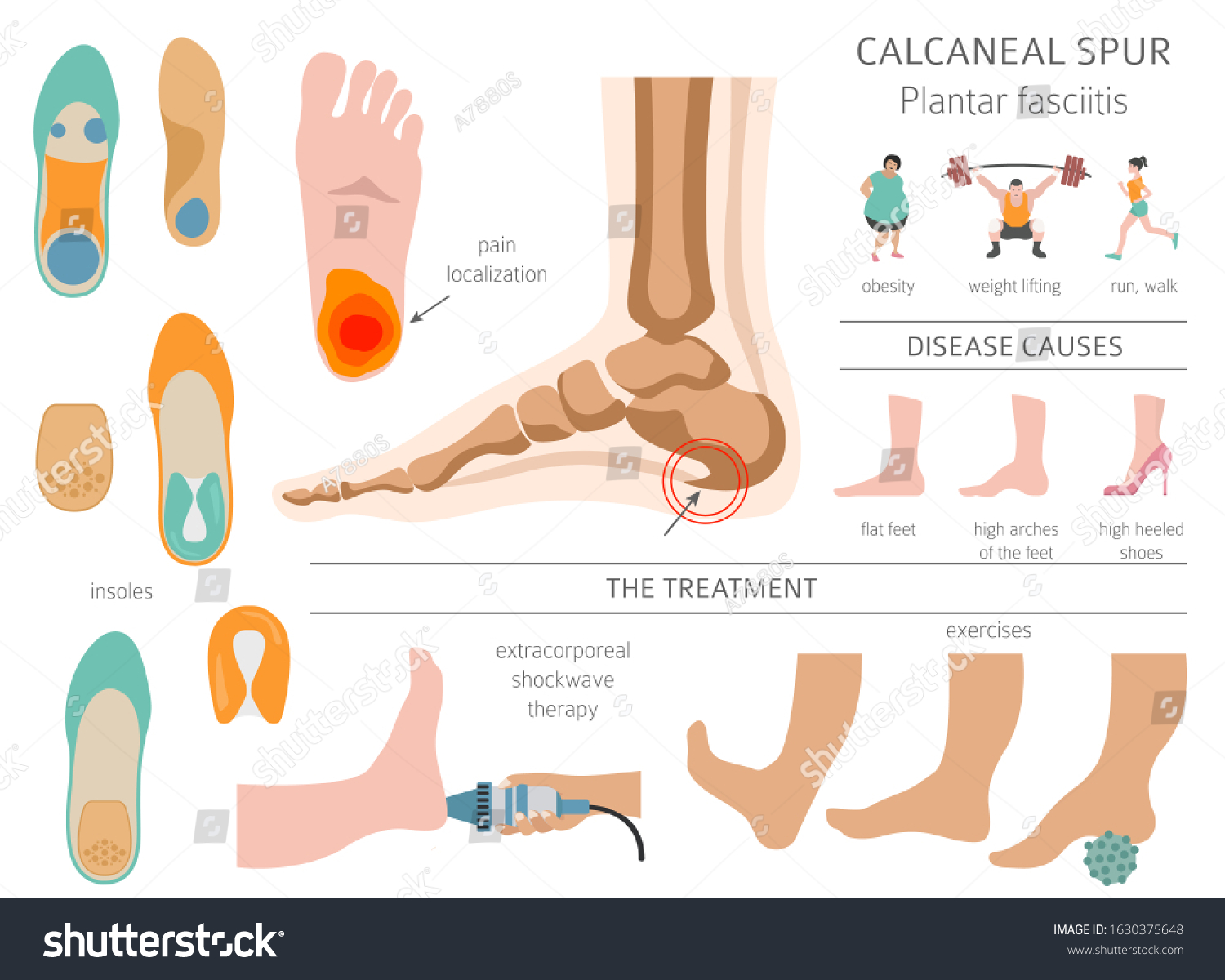 Calcaneal Spur Plantar Fasciitis Set Medical Stock Vector (Royalty Free ...