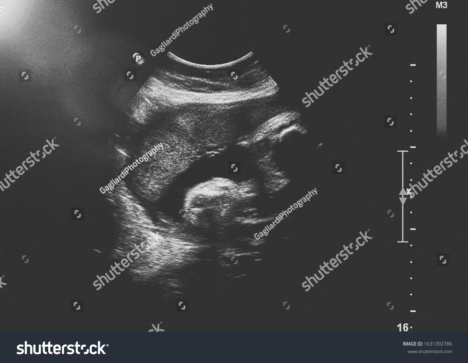 Ultrasound Fetus Third Month Pregnancy Stock Photo 1631392786