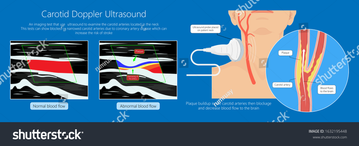 Coronary Artery Disease Cad Diagnosis Carotid Stock Vector (Royalty ...