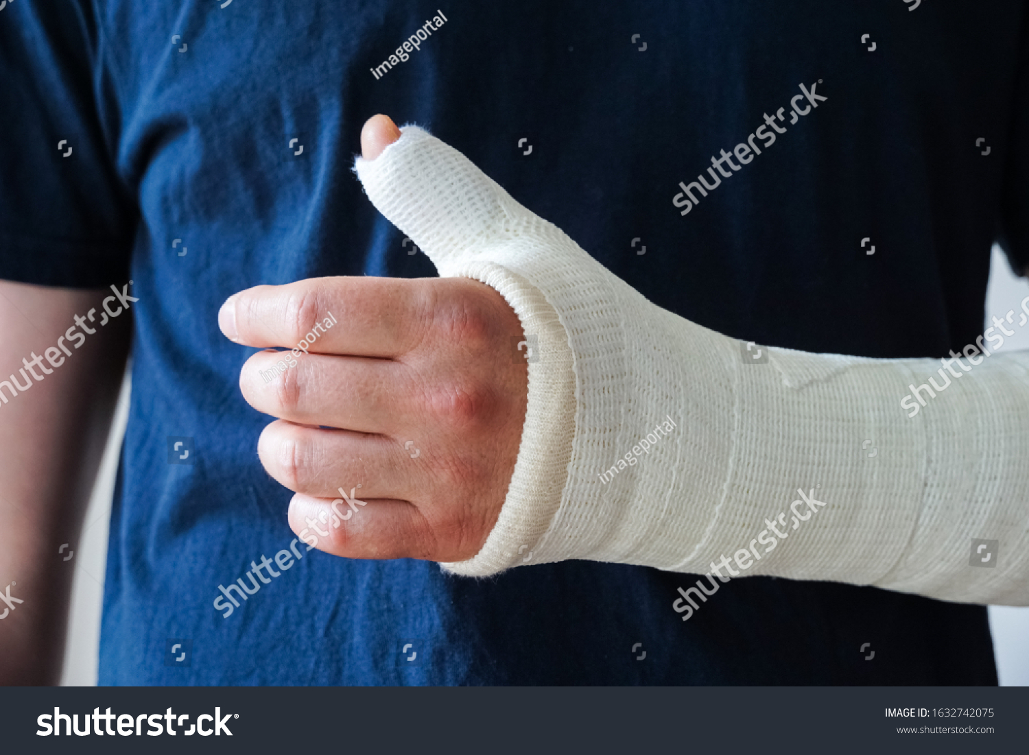 Thumb Spica Cast 131 Images Photos Et Images Vectorielles De Stock Shutterstock