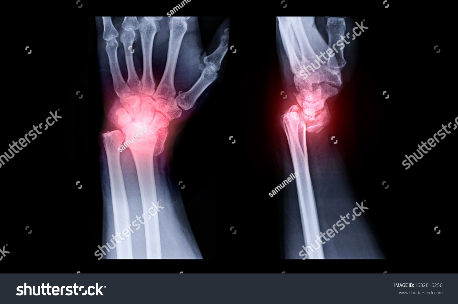 8,639 Wrist Bone Fractures Images, Stock Photos & Vectors | Shutterstock