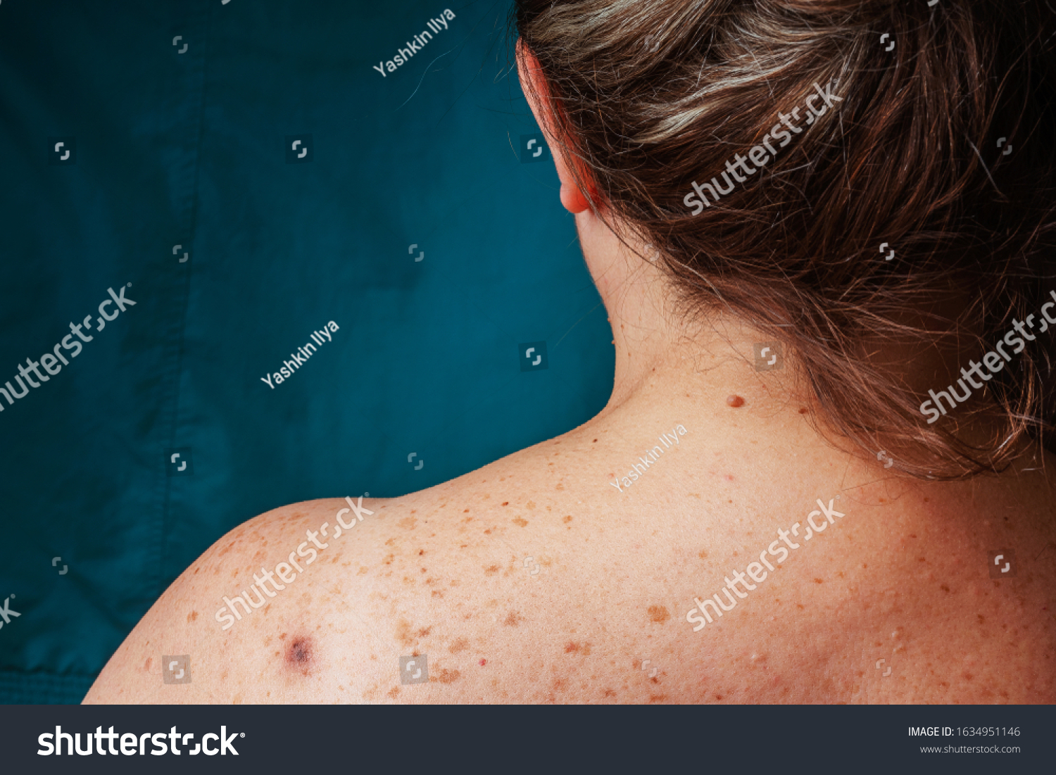 Age Spots Moles Freckles On Back Foto De Stock 1634951146 | Shutterstock