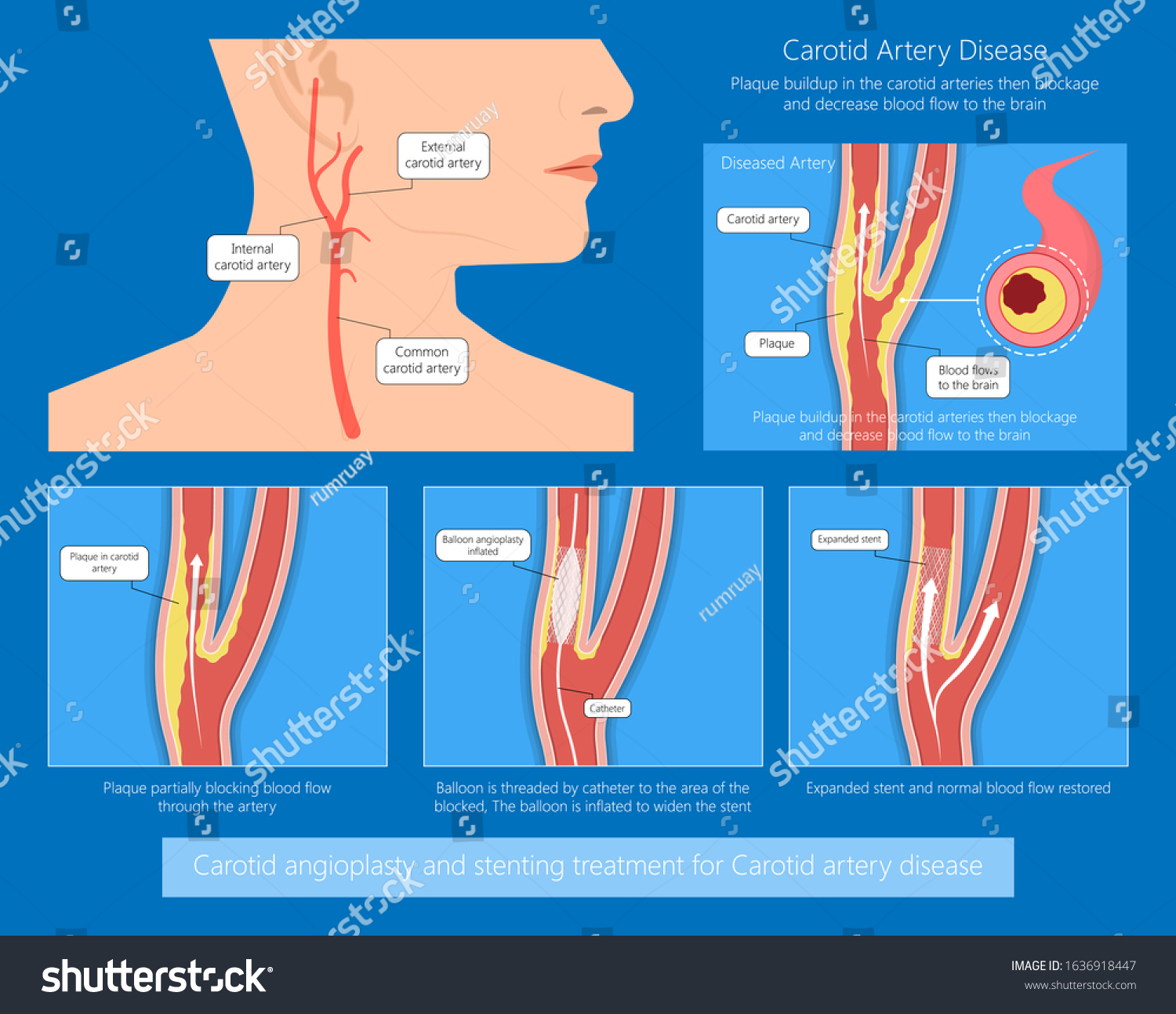 testing-for-carotid-stenosis-cerebrovascular-disease-jama-jama