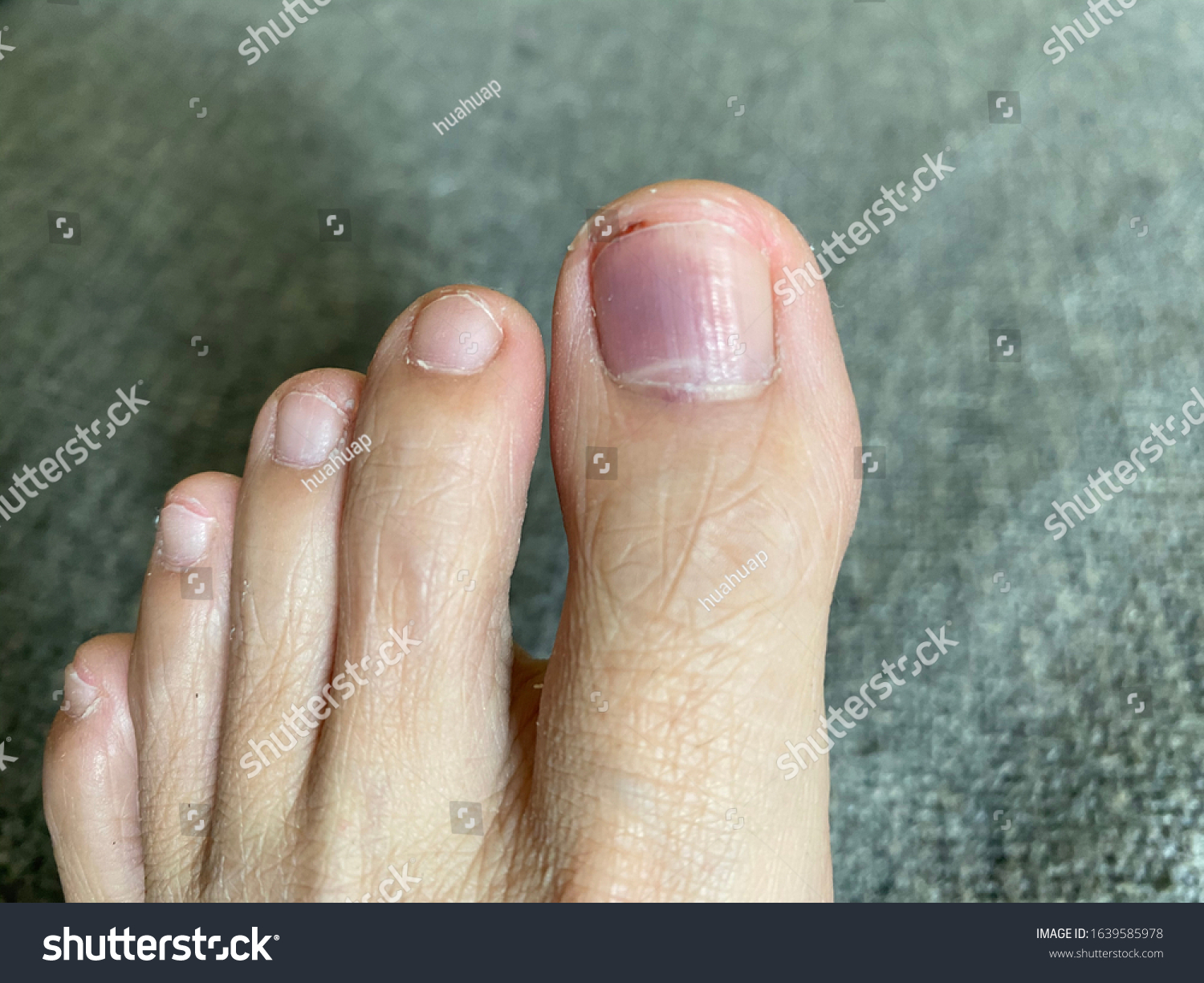 Subungual Hematoma Bleeding Under Toe Nail Stock Photo 1639585978 ...