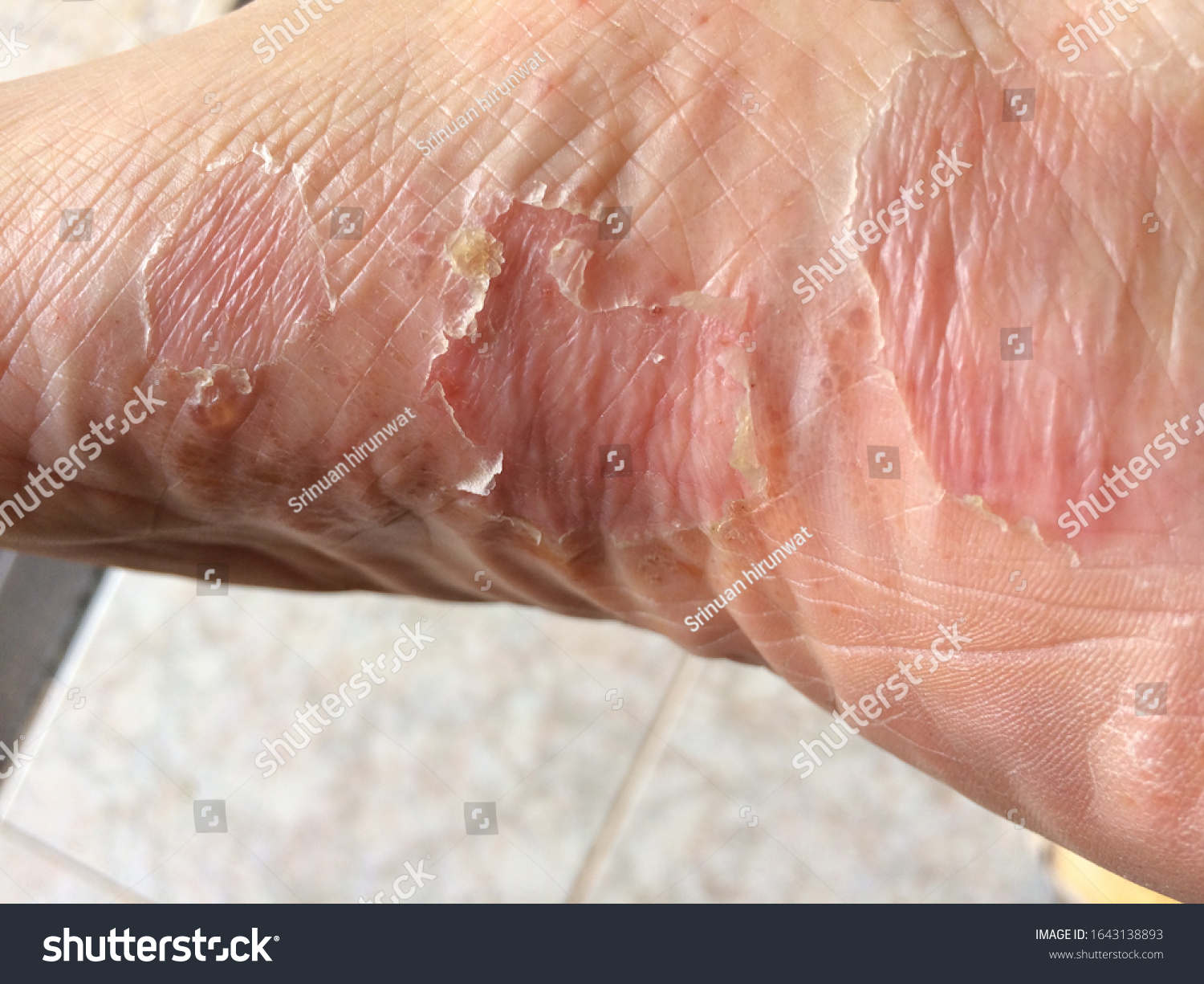 peeling-skin-rash-on-feet-must-stock-photo-1643138893-shutterstock