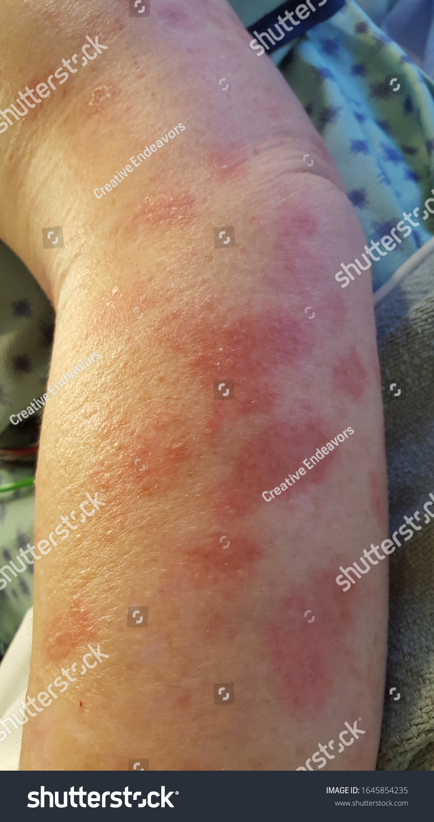 Erythema Multiforme Annular Erythematous Targetoid Skin Foto Stok