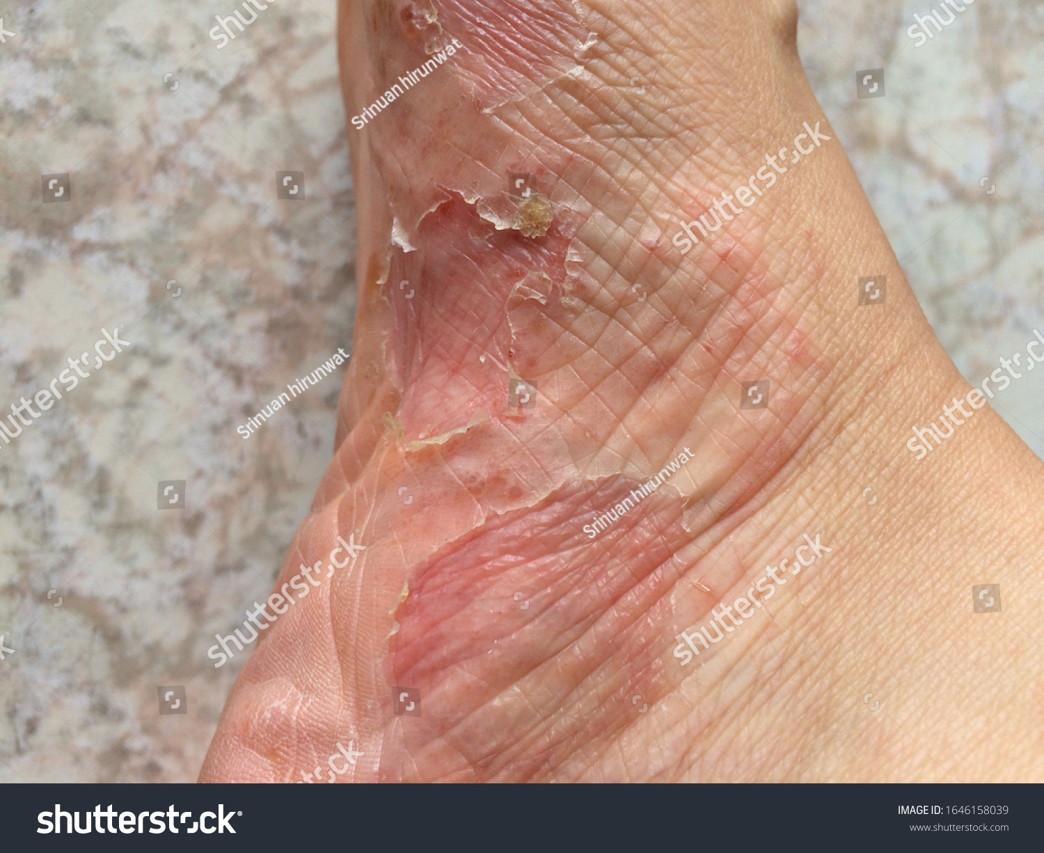 peeling-skin-rash-on-feet-must-stock-photo-1646158039-shutterstock