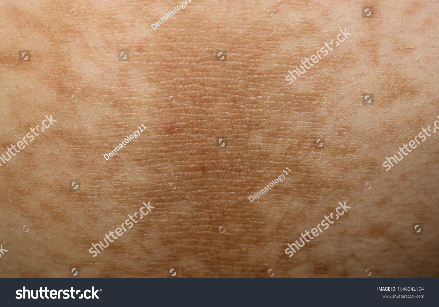 Case Acanthosis Nigricans Male Diabetes Stock Photo 1646342104
