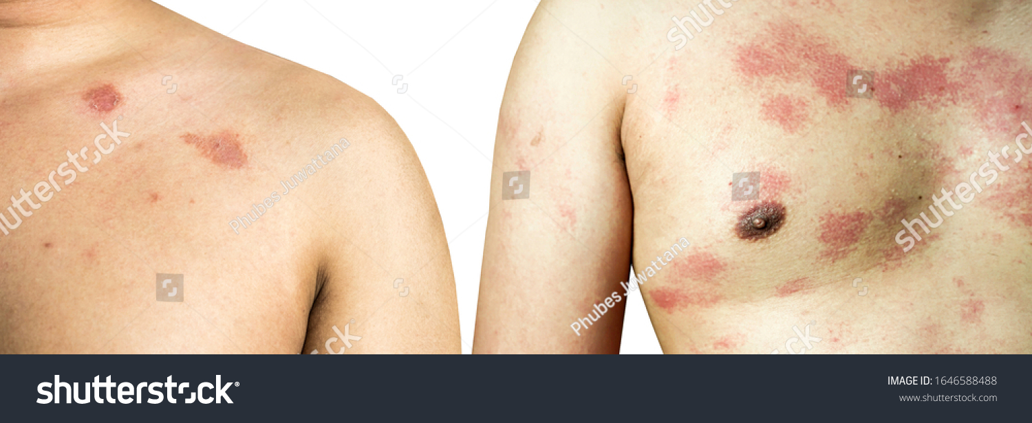 Ringworm On Body Caused By Fungus Stock Photo 1646588488 | Shutterstock