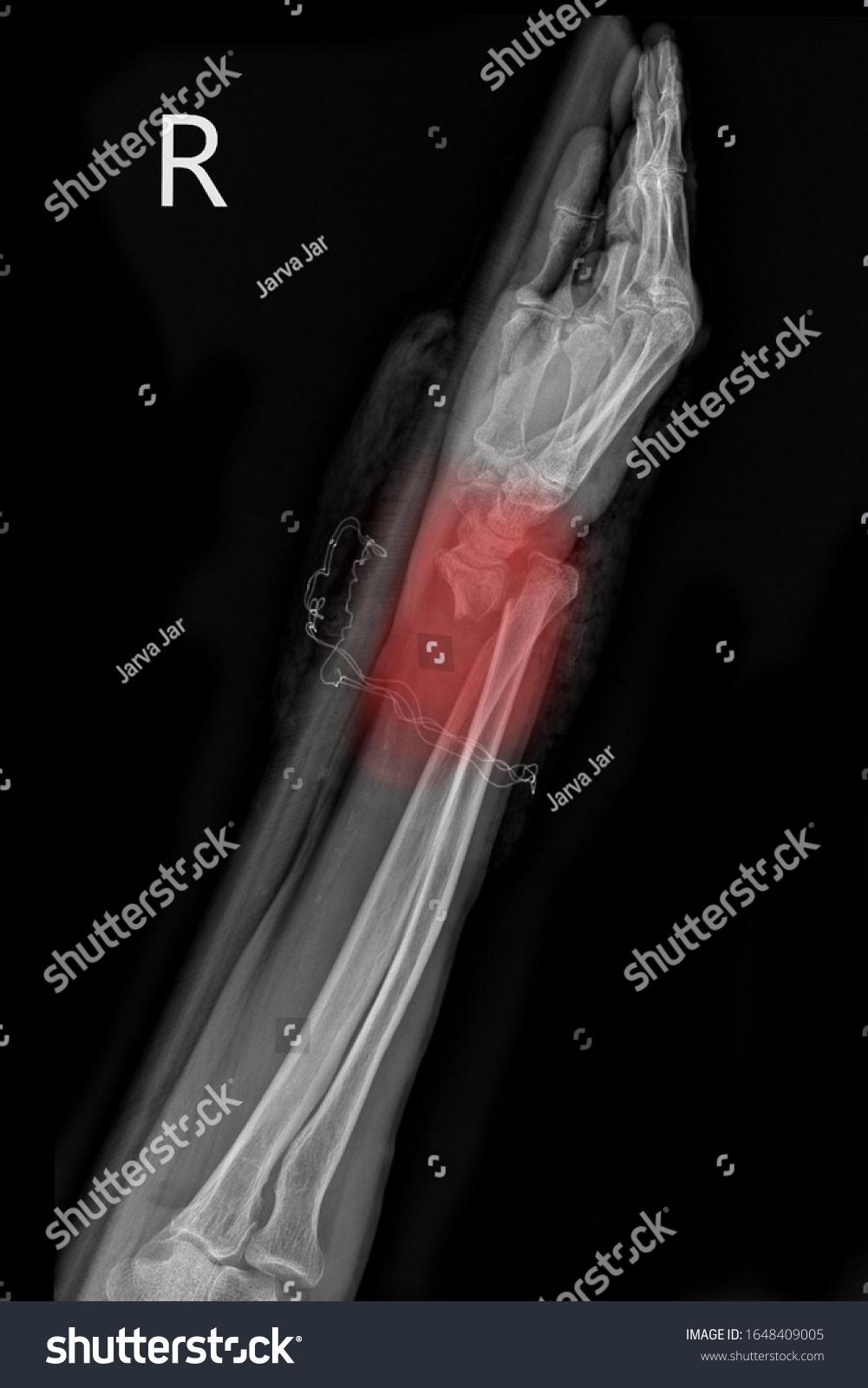 Closed Fracture Radius Right Hand Stock Photo 1648409005 