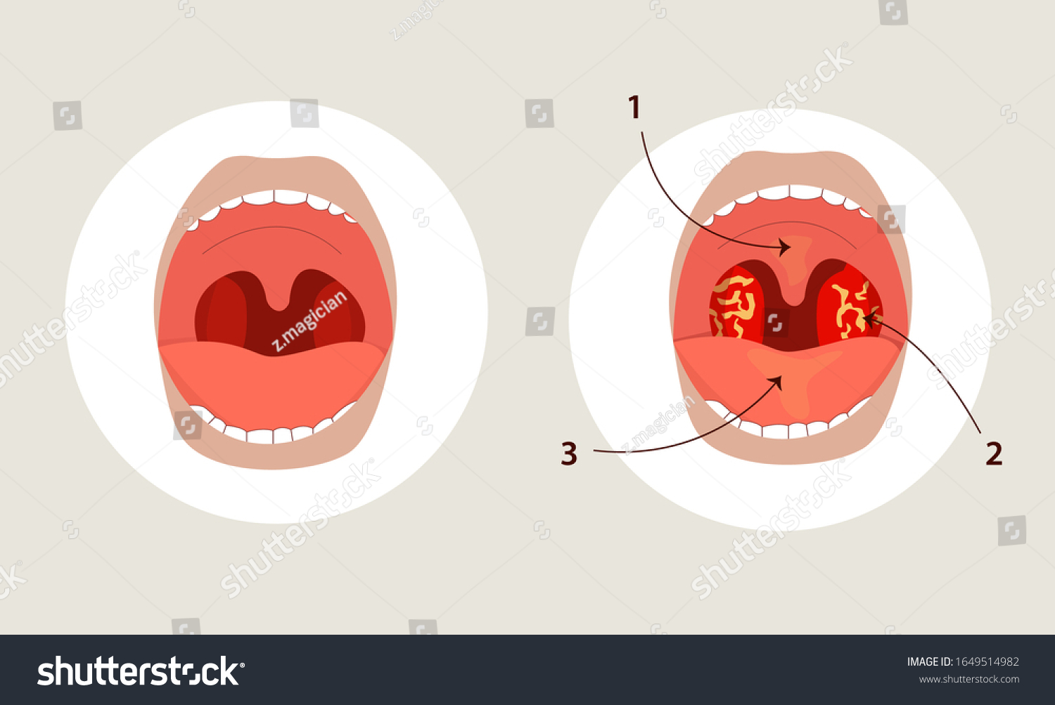 Tonsillitis Bacterial Viral Vector Illustration Angina Stock Vector