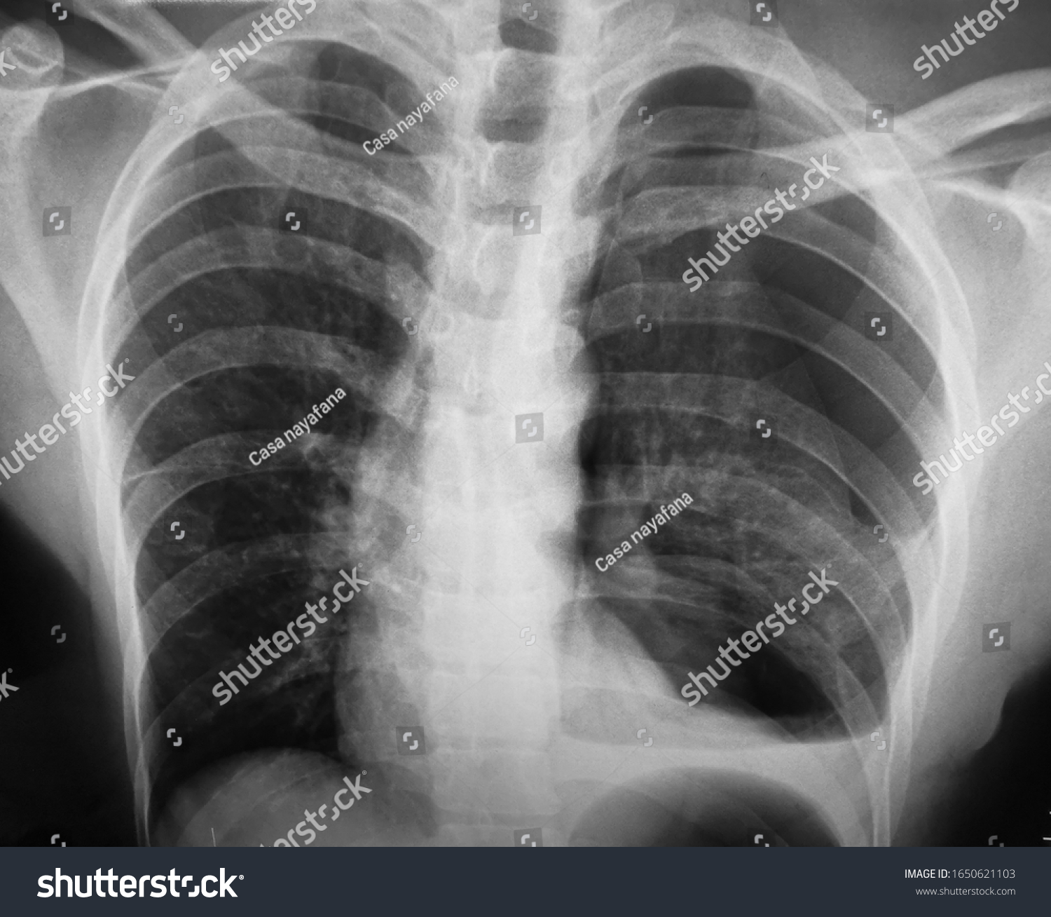 Xray Showing Left Lung Pneumothorax Grain Stock Photo 1650621103 ...