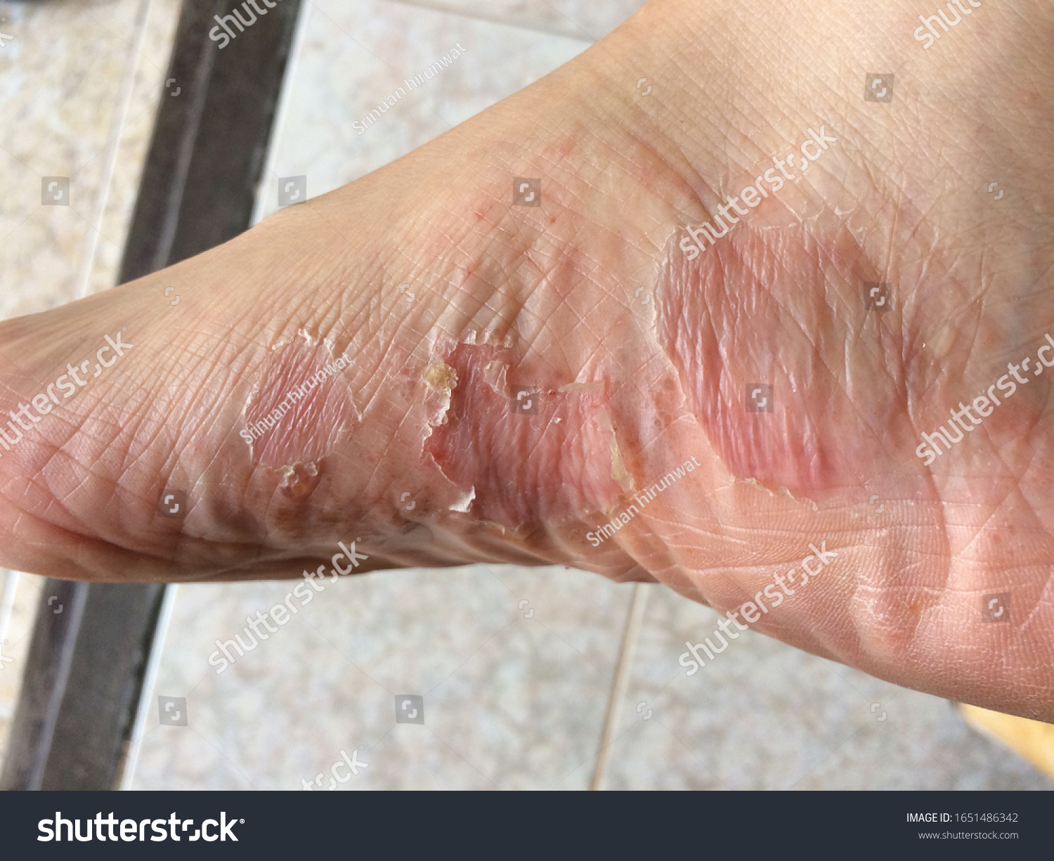 peeling-skin-rash-on-feet-must-stock-photo-1651486342-shutterstock