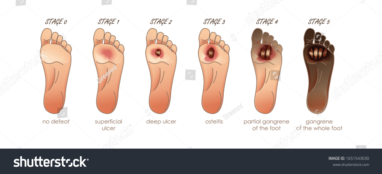 diabetes foot artwork clipart