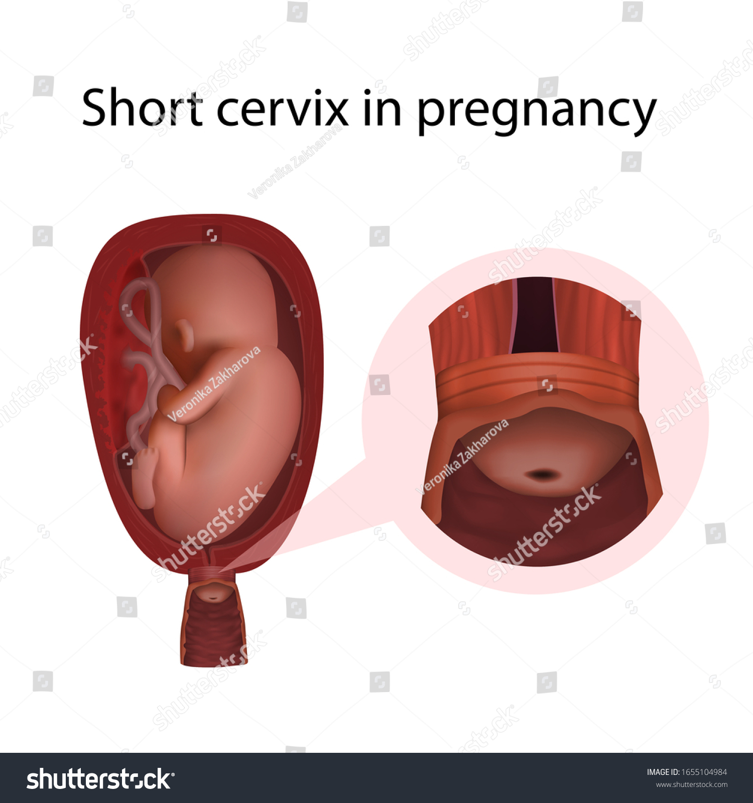 Short Cervix Pregnancy Fetus Uterus Womb Stock Illustration 1655104984