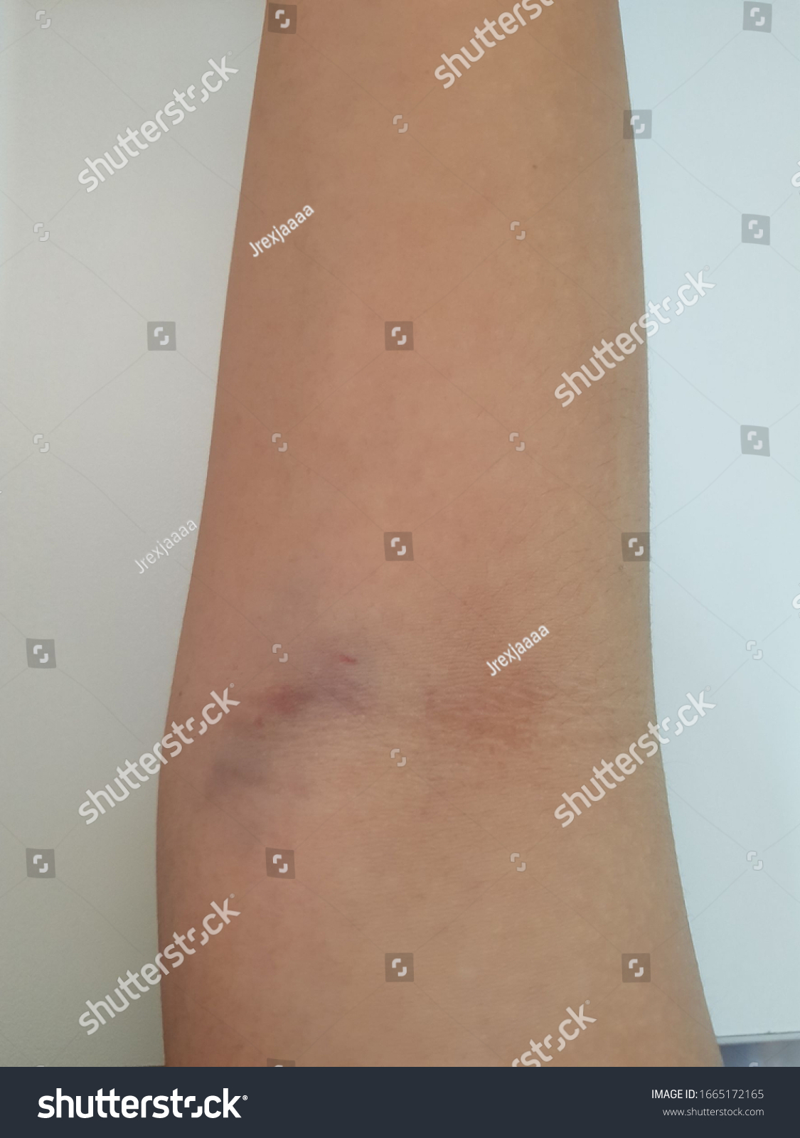 Arms Asian Woman Swelling After Bruising Stock Photo 1665172165