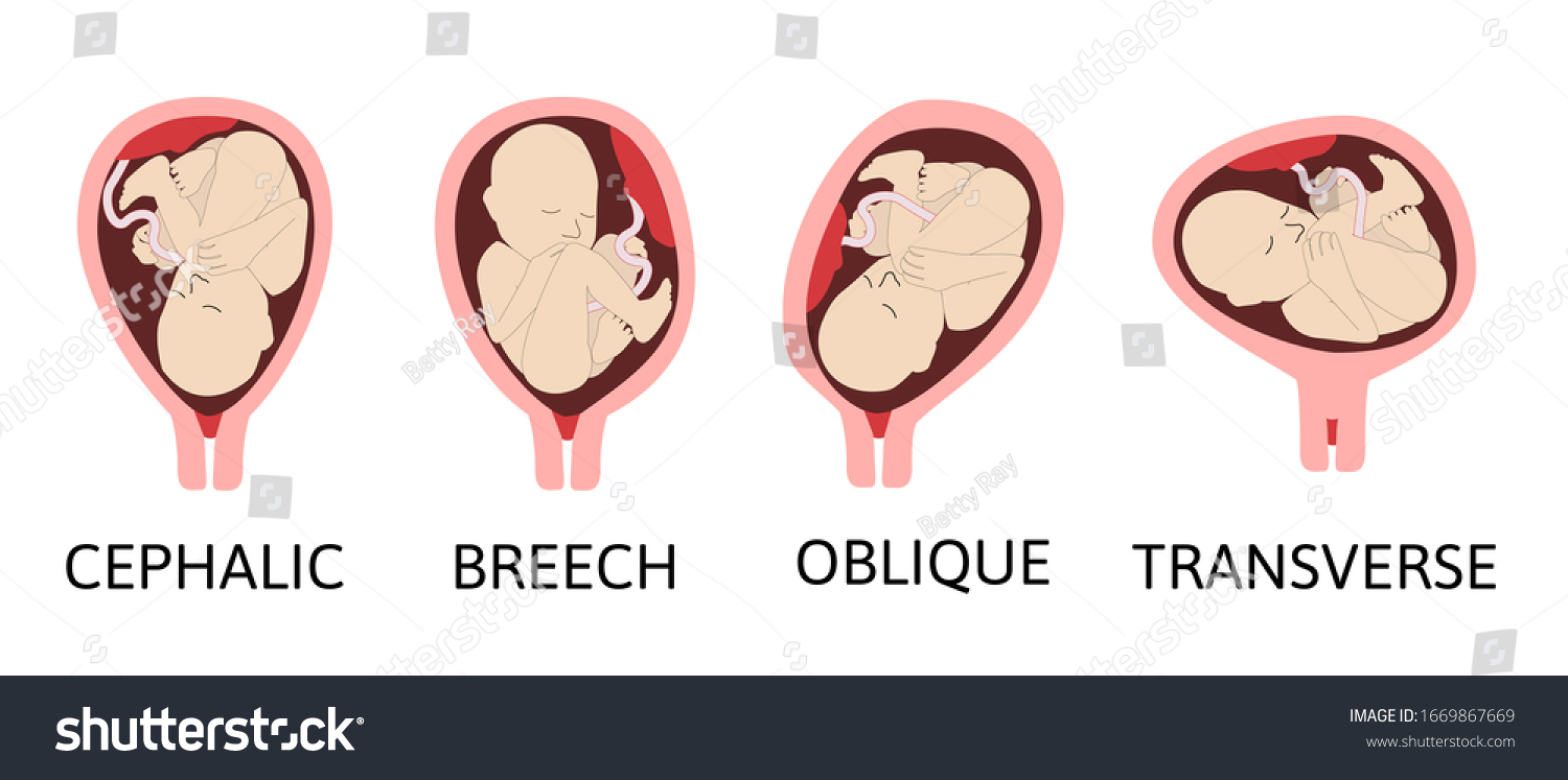 cephalic presentation of fetus means