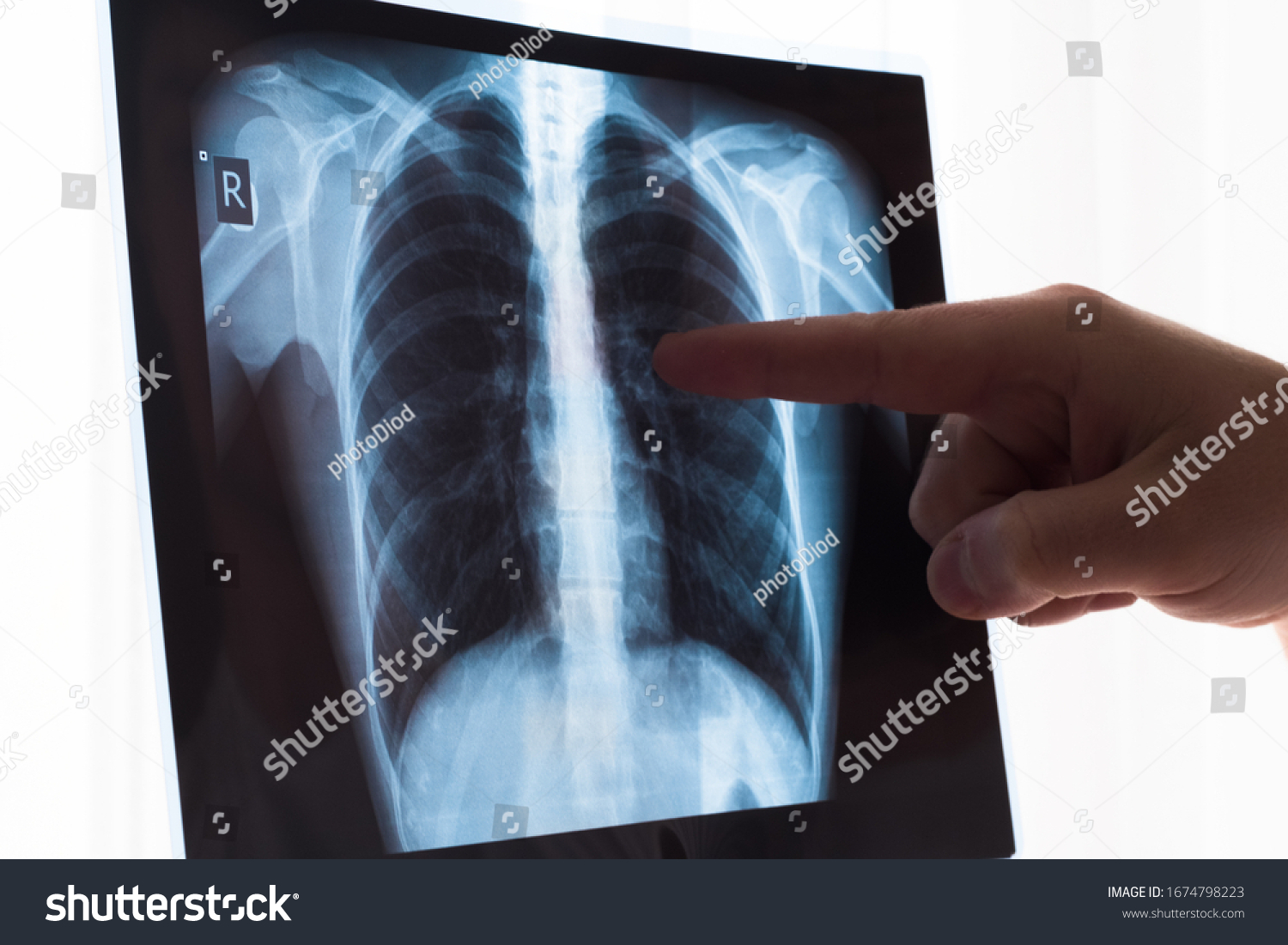 Lung Radiography Concept Radiology Doctor Examining Stock Photo ...